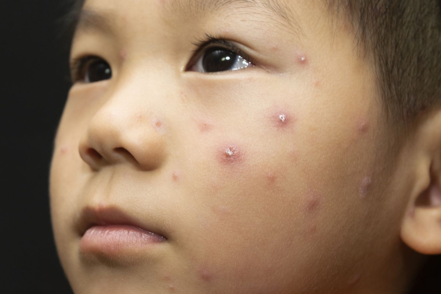 3 bệnh phổ biến lúc xuân sang và cách phòng tránh