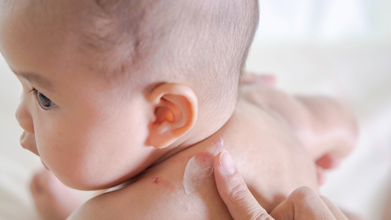 Giúp con dứt cơn ngứa ngáy do rôm sảy mùa nóng