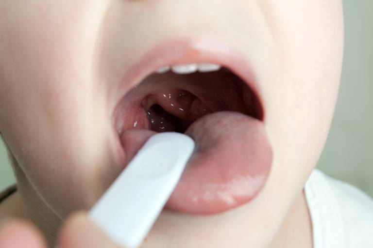 Dạng viêm họng trẻ hay mắc vào mùa đông xuân