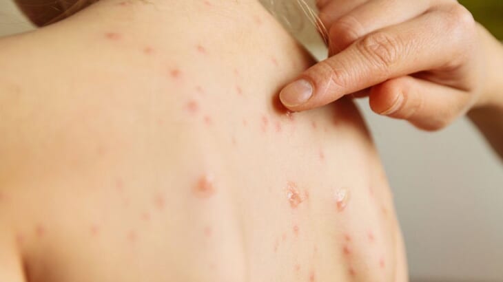 Sự khác biệt giữa sởi và sốt phát ban