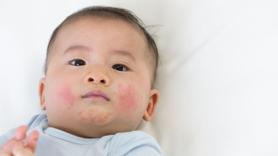 Trẻ viêm da cơ địa: Chăm sóc đúng cách từ bên trong
