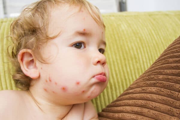 Dấu hiệu thủy đậu rõ nhất là mụn nước mọc toàn thân, kể cả trong miệng.