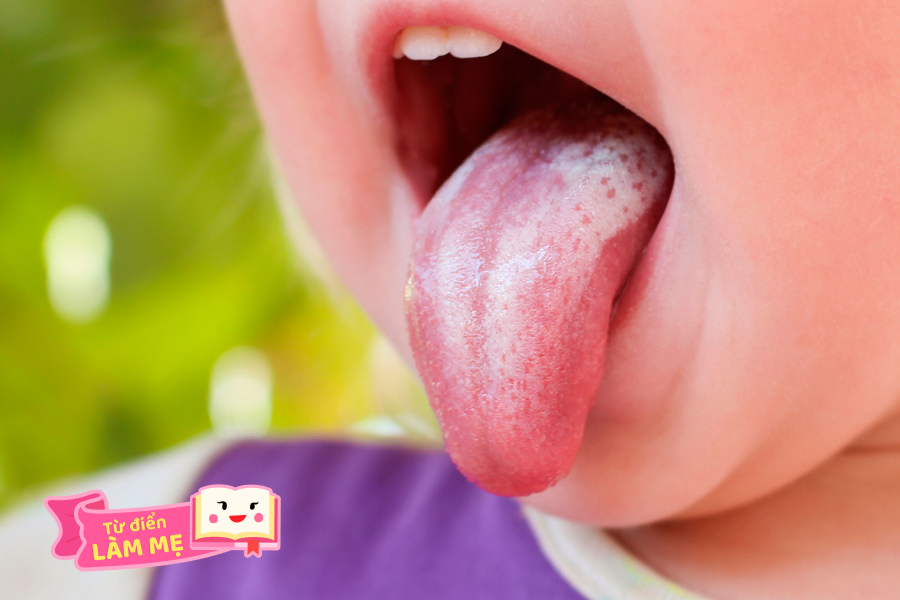 Tưa lưỡi ở trẻ em là gì, có nguy hiểm không?